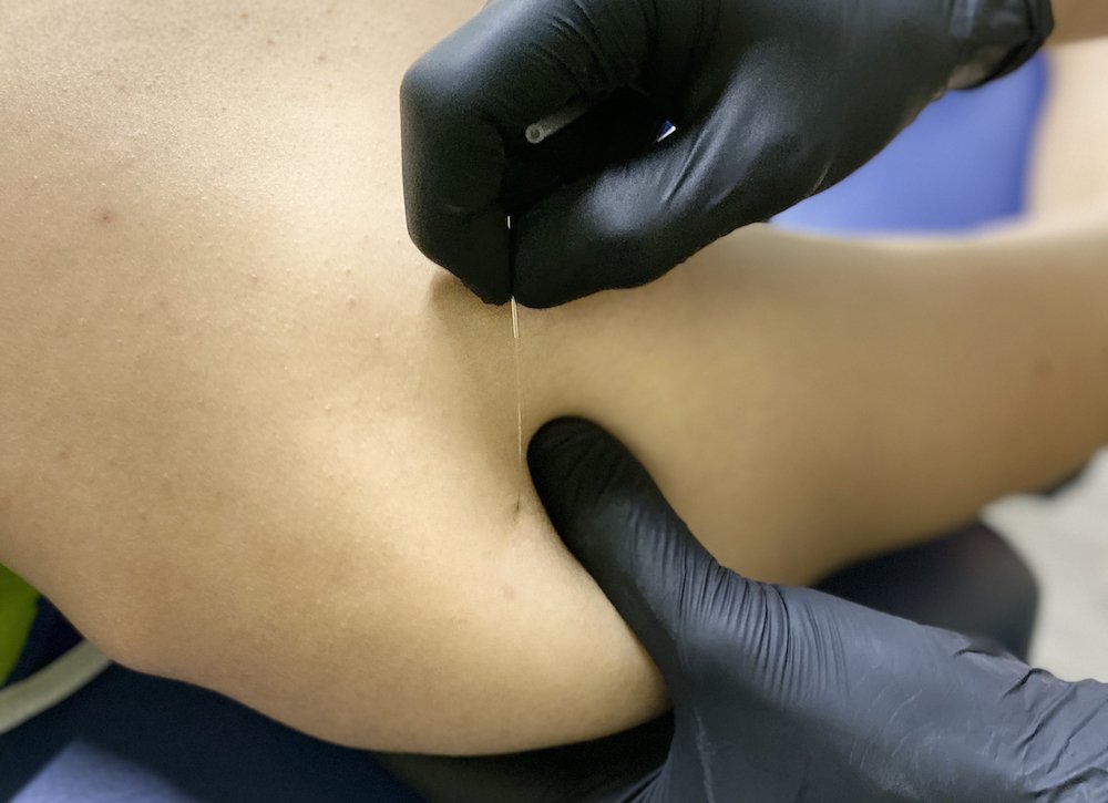 Physiotherapist performing a dry needling session on a patient